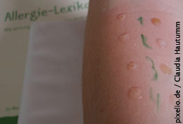 Mit einem einfachen Hauttest lassen sich bereits viele Allergien diagnostizieren