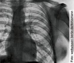 Röntgenbild der ersten Herzkatheterisierung (im Selbstversuch) durch Werner Forssmann. Auch er widerlegte damit falsche Annahmen durch Tierversuche